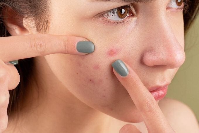 Jak na akné
